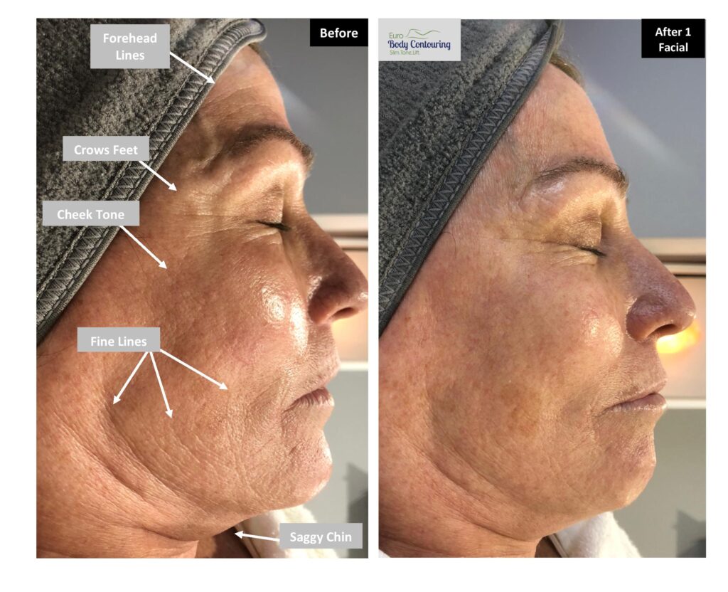 CryoFace Before and After