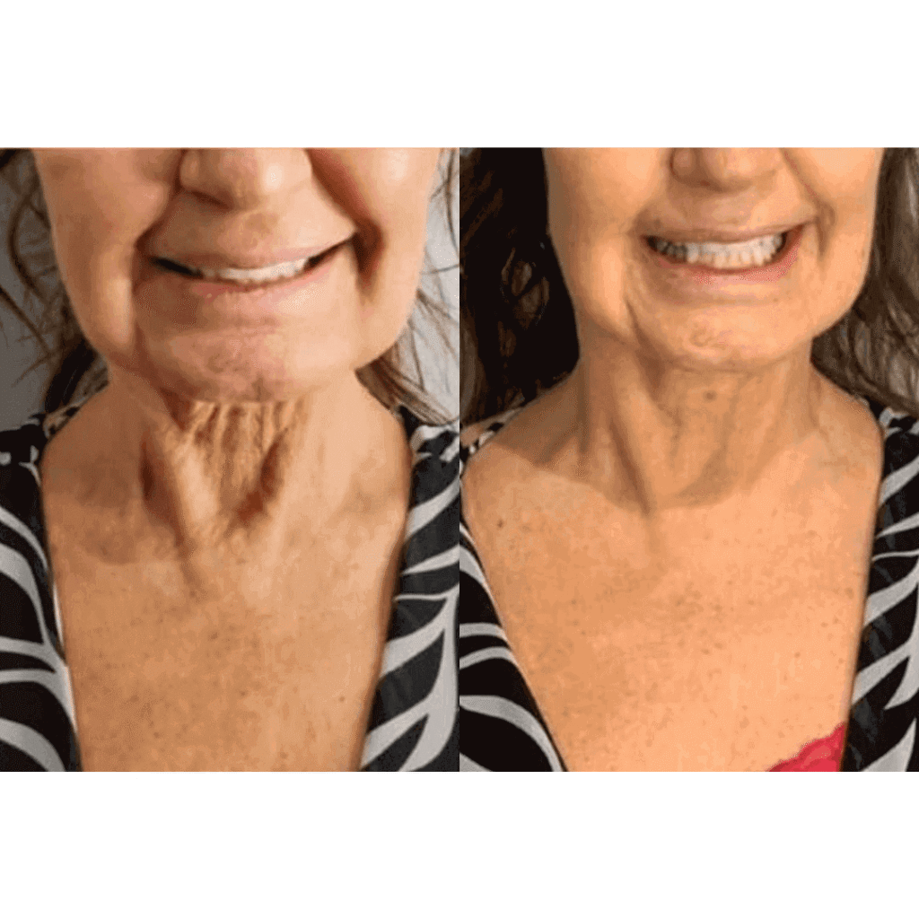 CryoFace Before and After