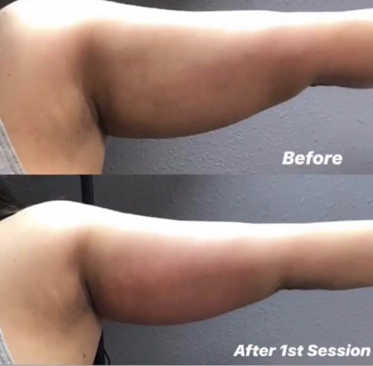 Arm after 1 session