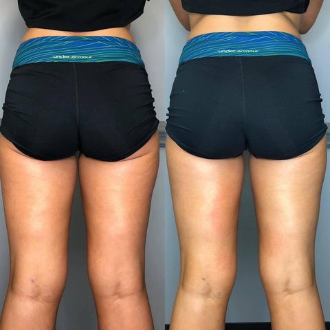 CryoSlim after 1 session
