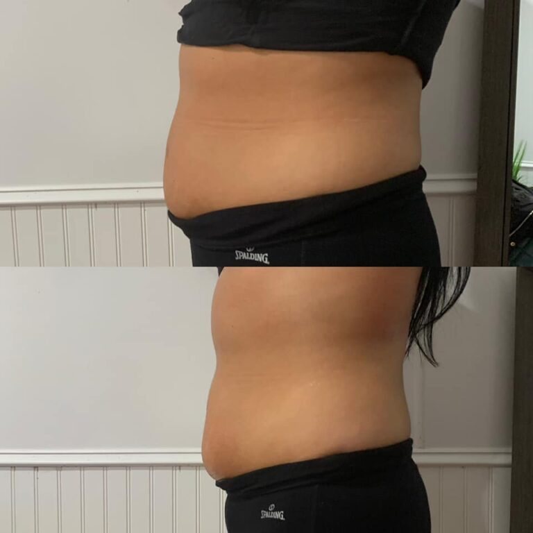 CryoSlim after 1 Session