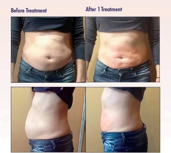 CryoSlim after 1 session
