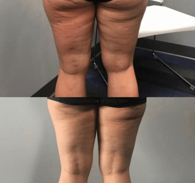 CryoTone after 1 Session