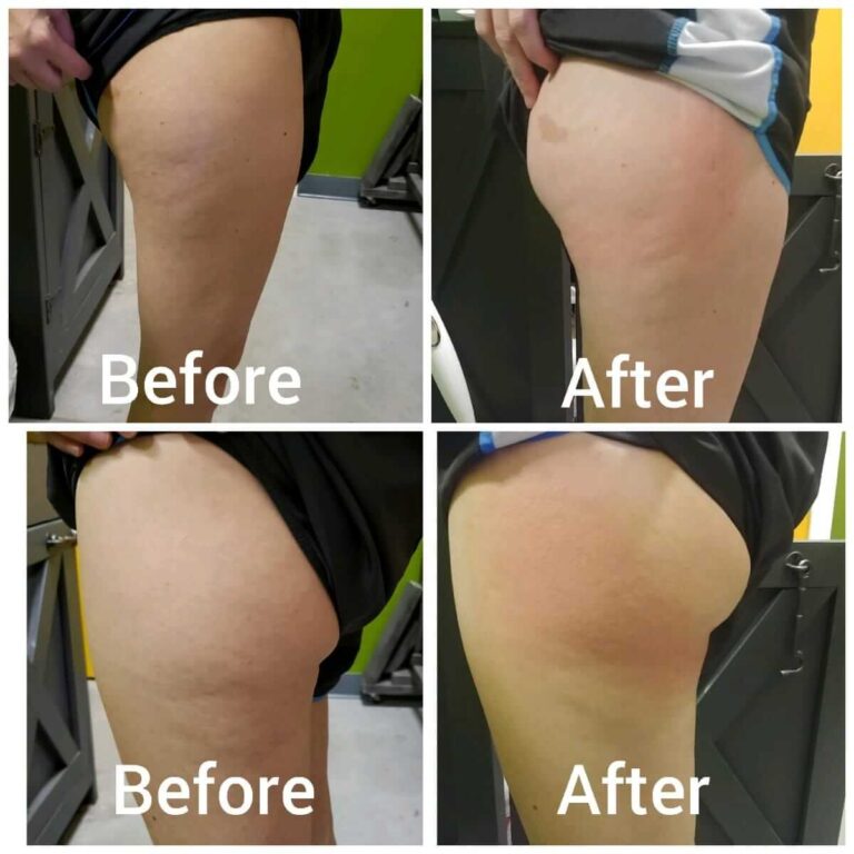 CryoTone after 1 Session