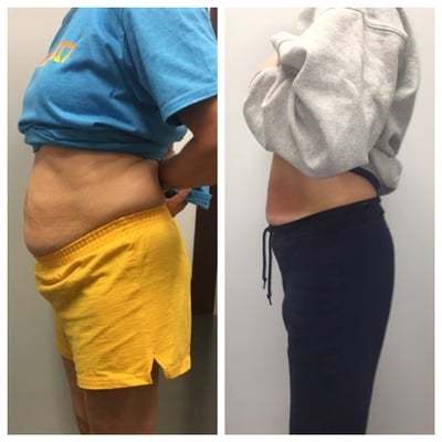 CryoSlim after 15 Sessions