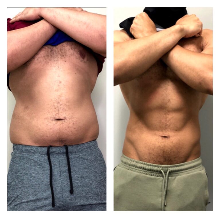 CryoSlim after 19 Sessions