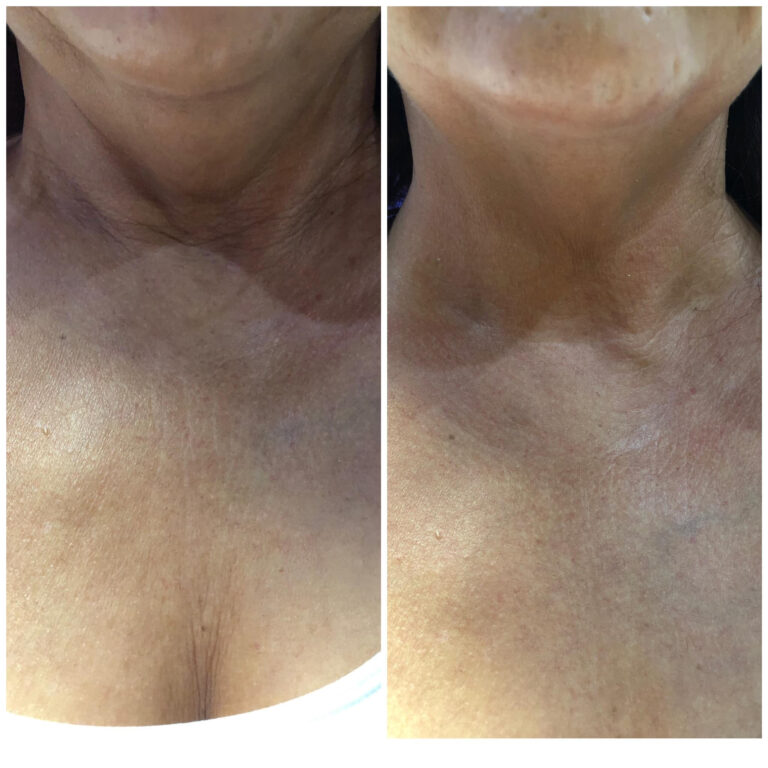 CryoSlim after 2 sessions