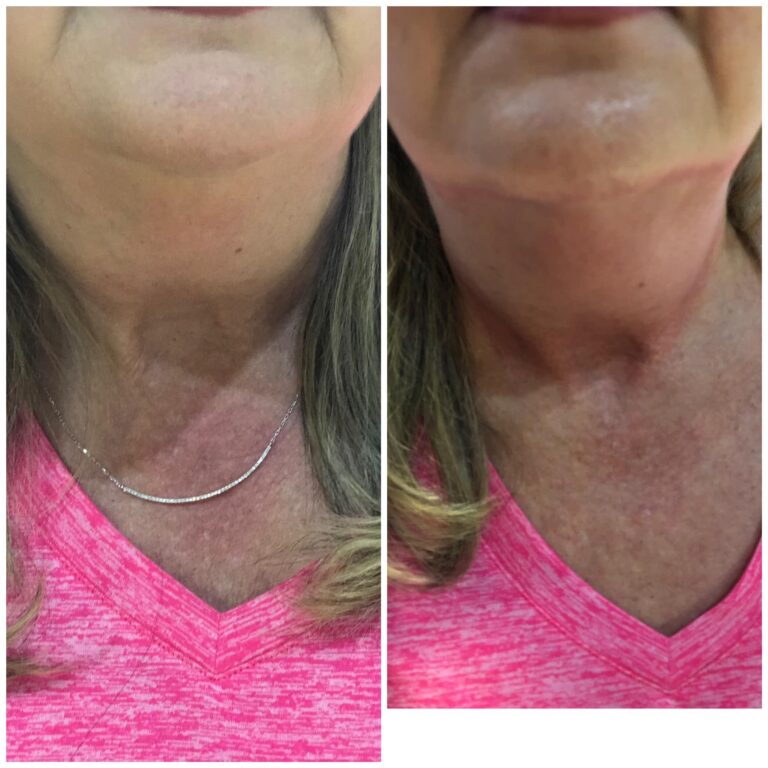 CryoSlim after 2 sessions