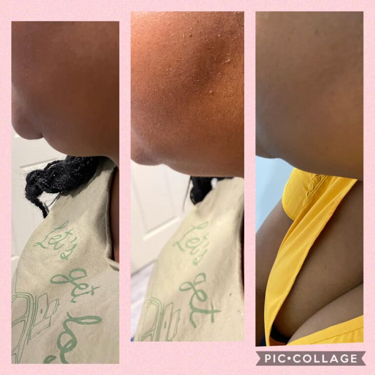 CryoSlim after 2 sessions