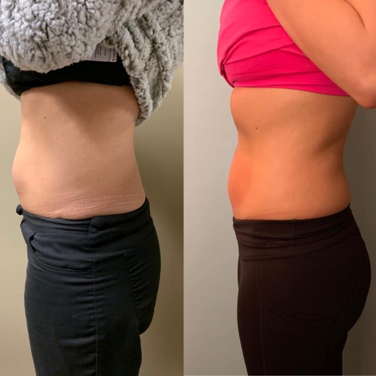 CryoSlim after 2 sessions