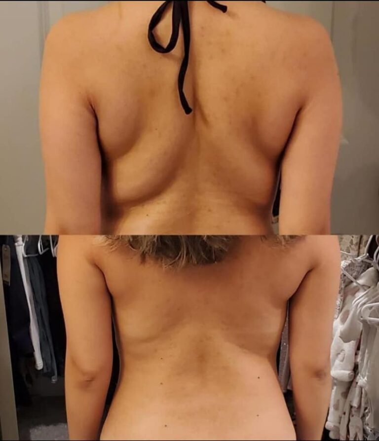 CryoSlim after 2 sessions