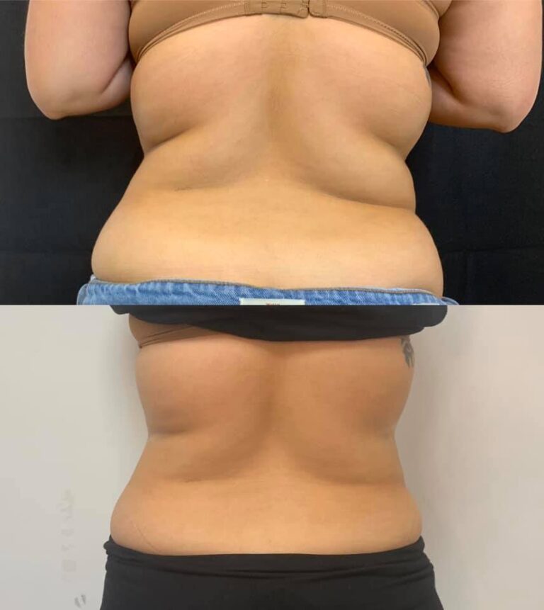 CryoSlim after 2 sessions