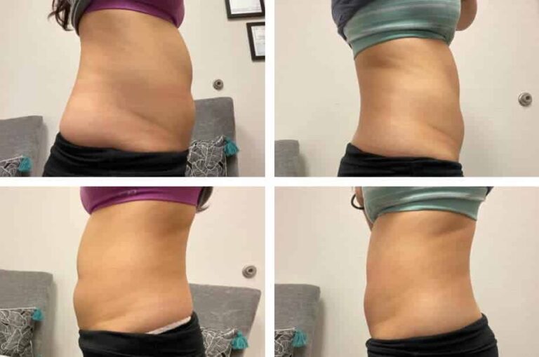 CryoSlim after 2 Sessions
