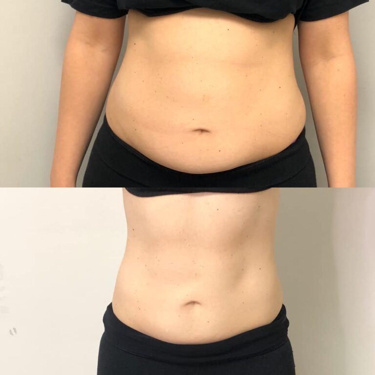 CryoSlim after 2 Sessions