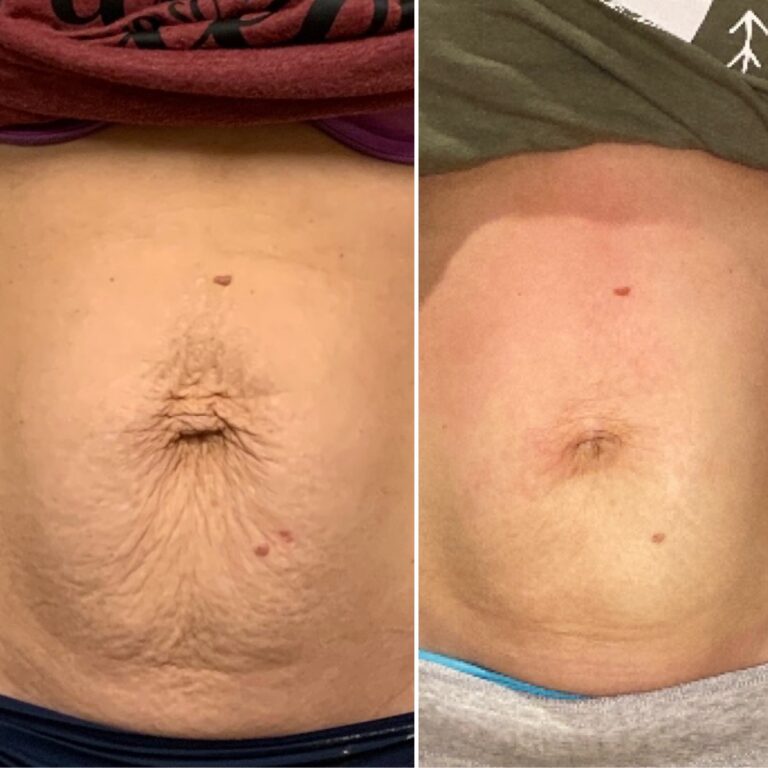 CryoTone after 3 Sessions