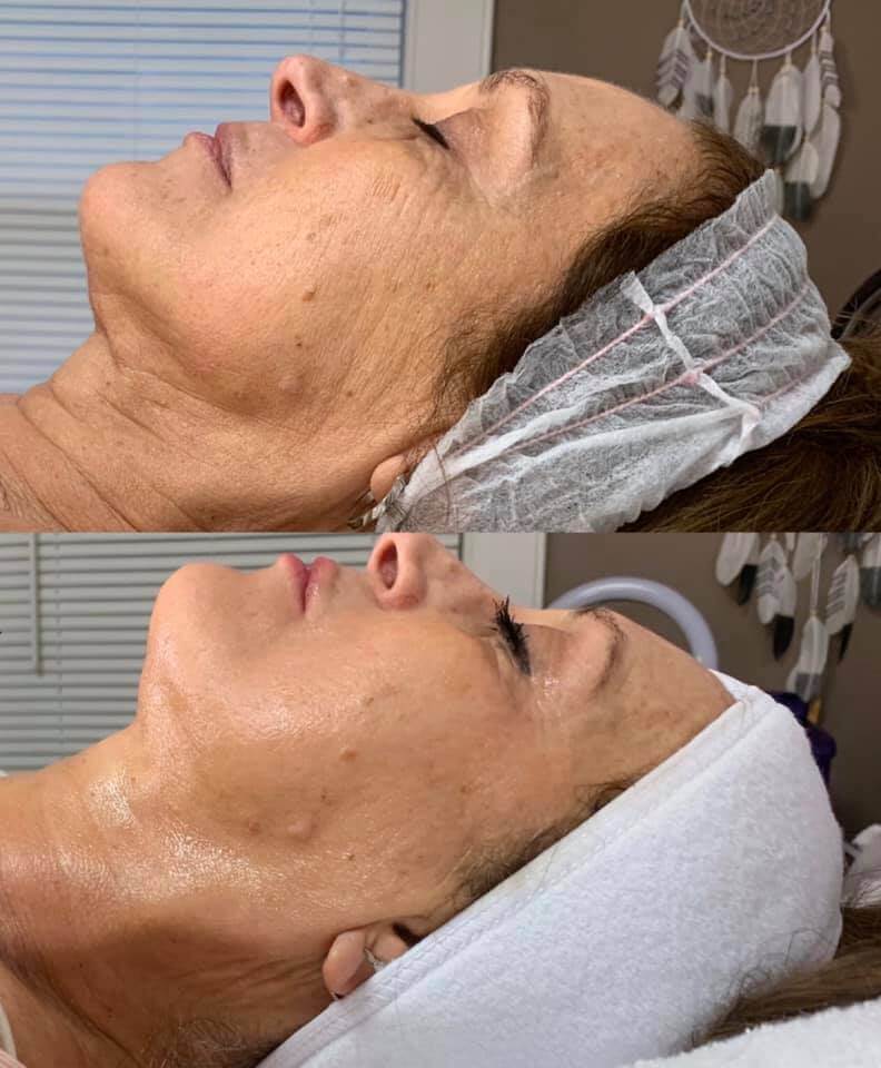 CryoFace Before and After
