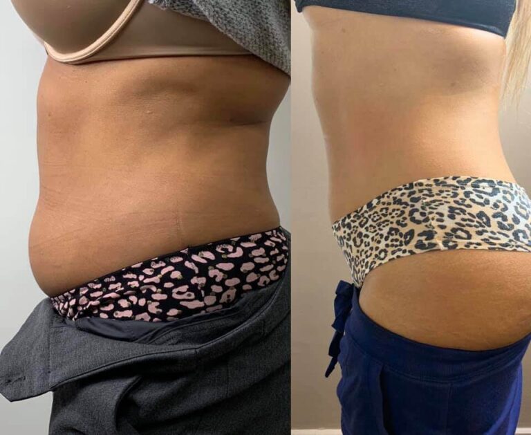 CryoSlim after 3 sessions