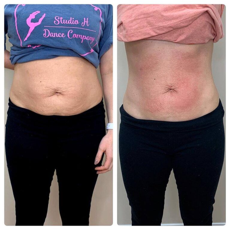 CryoSlim after 3 sessions