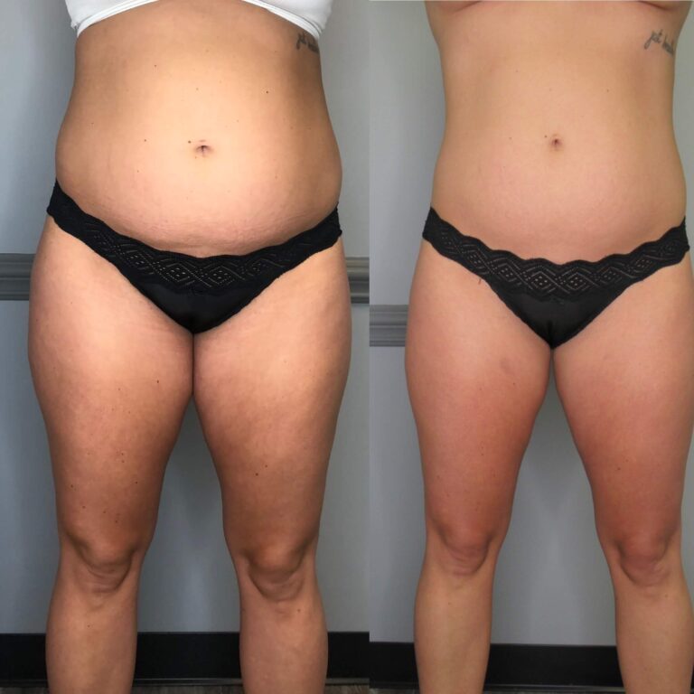 CryoSlim after 3 Sessions and CryoTone after 3 Sessions