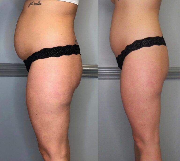 CryoSlim after 3 Sessions and CryoTone after 3 Sessions