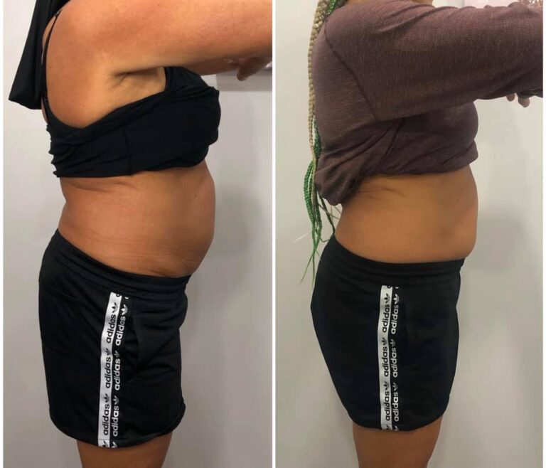 CryoSlim after 3 Sessions and CryoTone after 5 Sessions