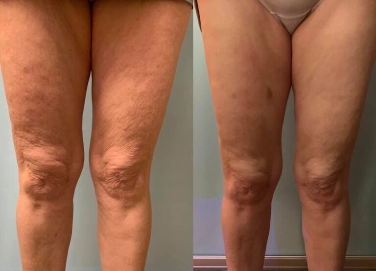 CryoTone after 3 Session and 2 CryoSlim Sessions