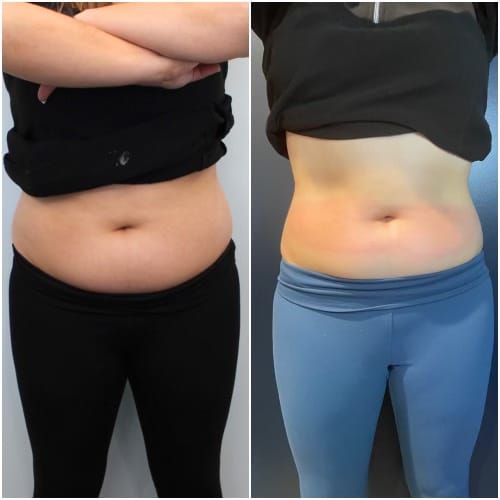 CryoSlim after 4 Sessions