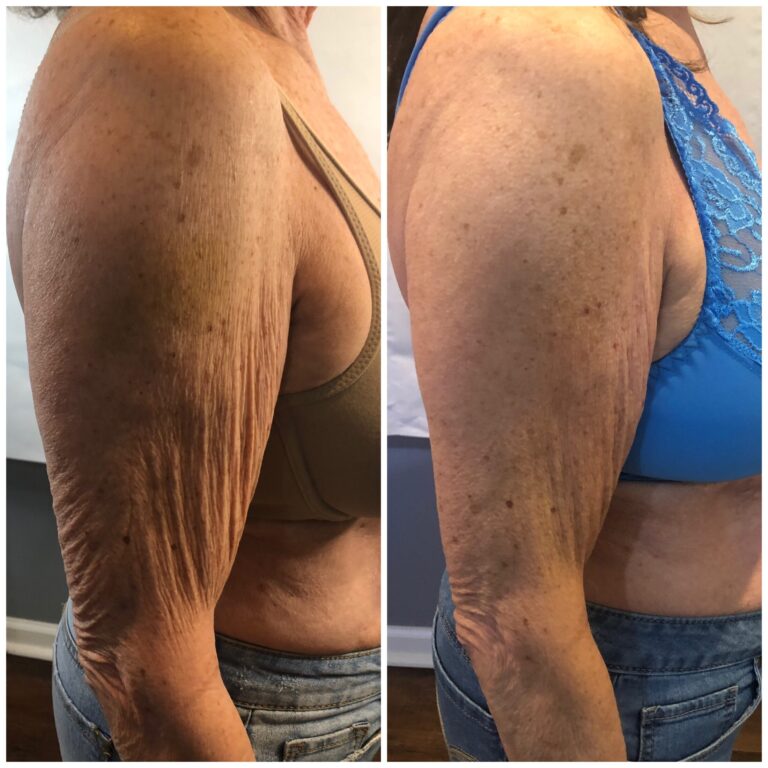 CryoTone after 4 Sessions