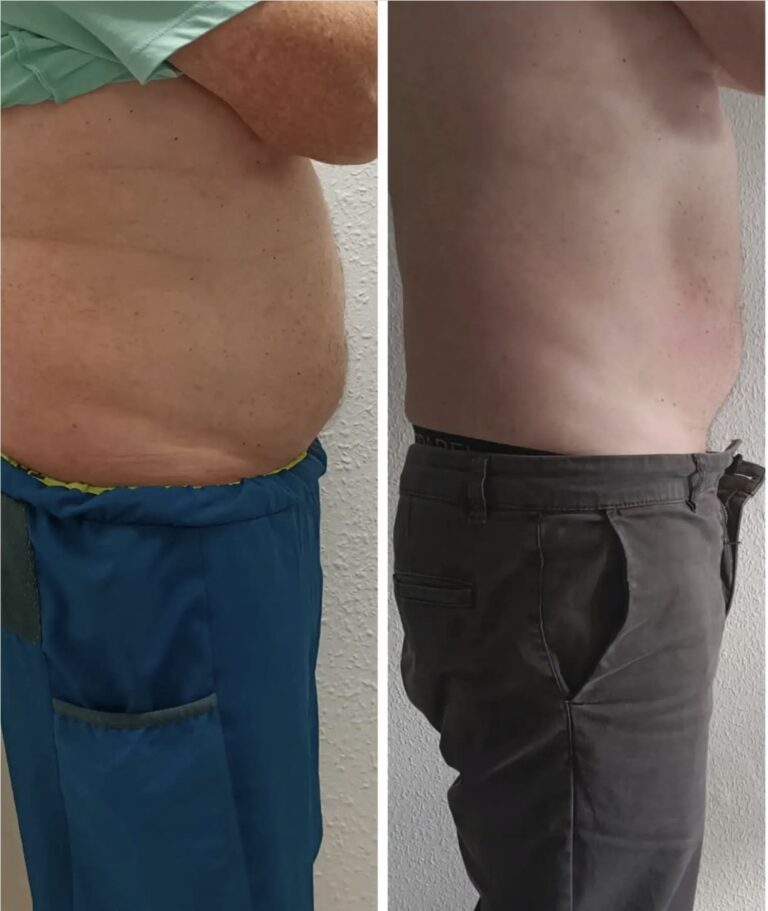 CryoSlim after 4 Sessions