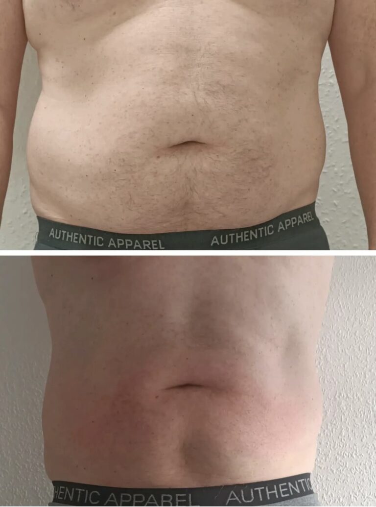 CryoSlim after 4 Sessions