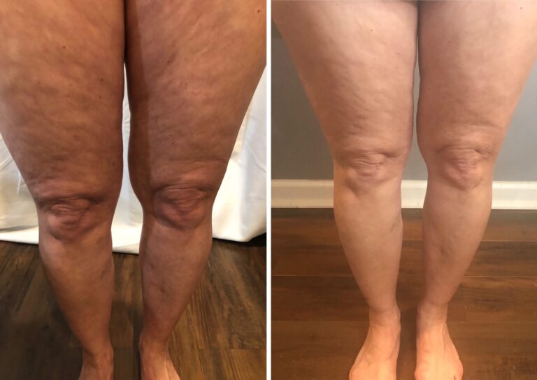 CryoTone after 5 Sessions
