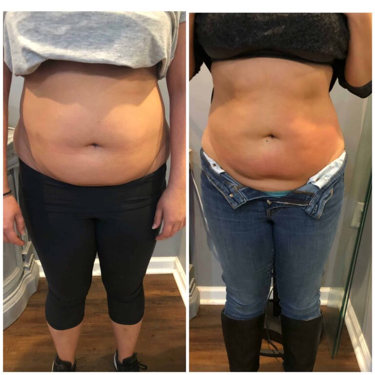 CryoSlim after 5 Sessions