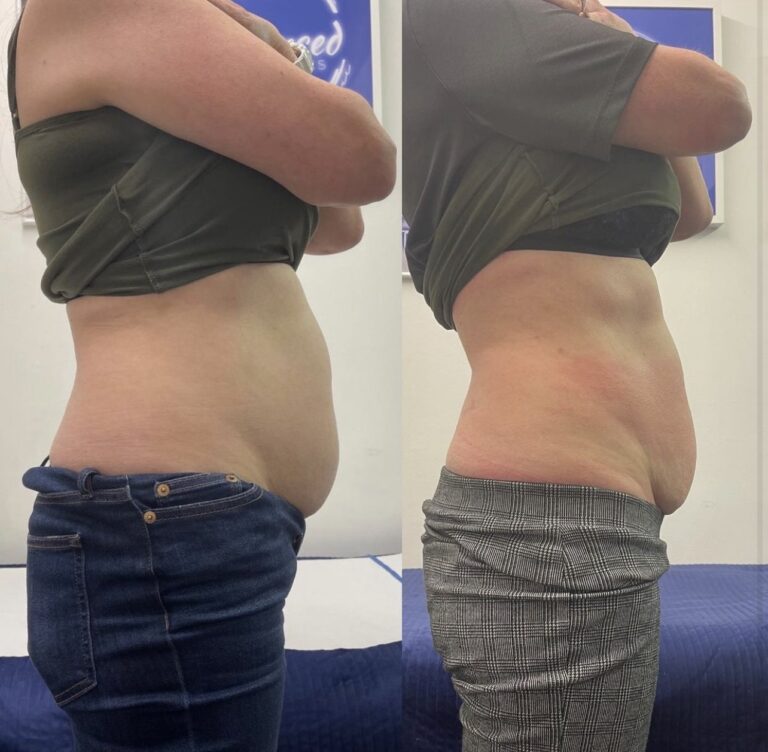CryoSlim after 5 sessions
