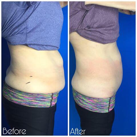 CryoSlim after 6 Sessions