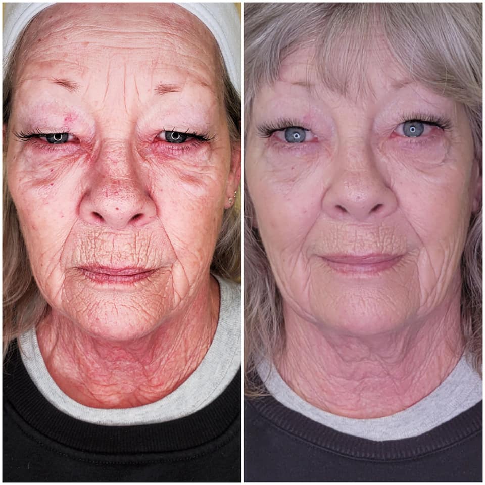 CryoFace Before and After