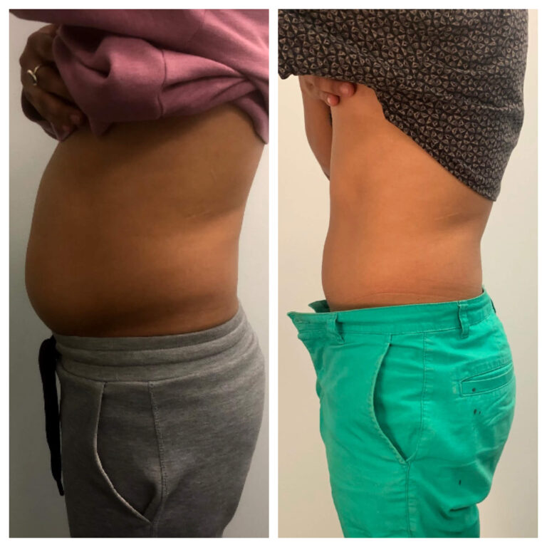 CryoSlim after 8 Sessions