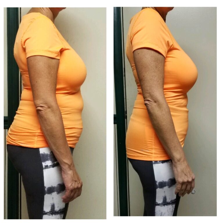 Abdomen Side Before and After