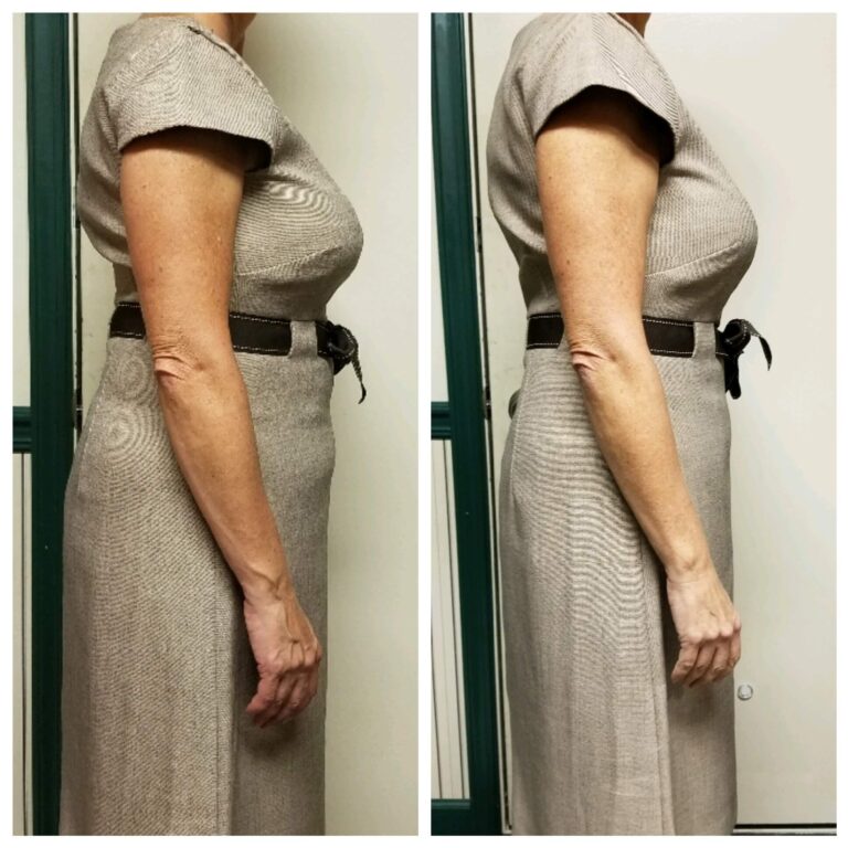 Abdomen Side Before and After