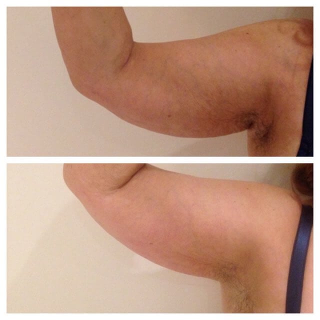 Arm Before and After