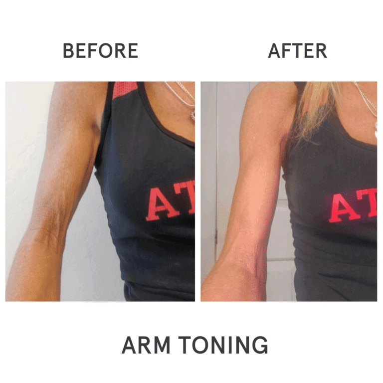 CryoTone after 5 Sessions