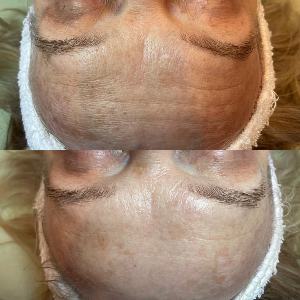 CryoFace Before and After