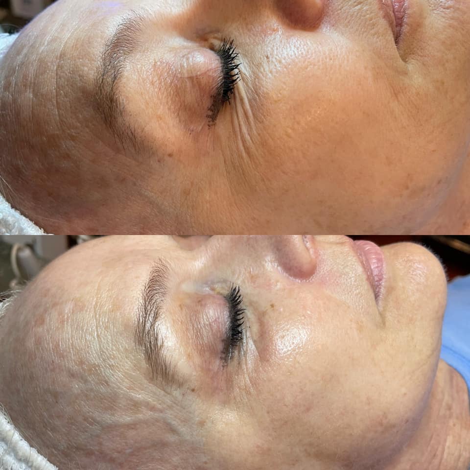 CryoFace Before and After