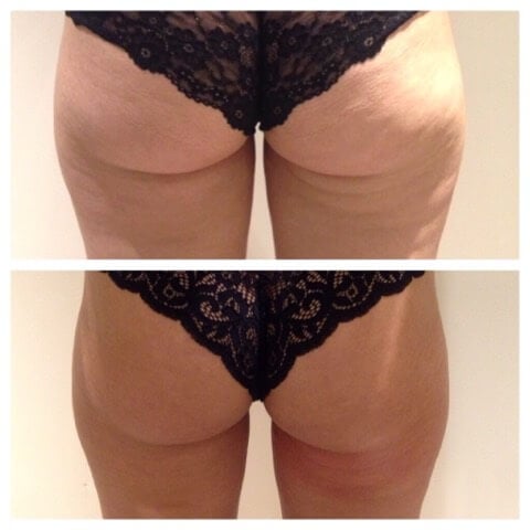 CryoTone Thighs Before and After