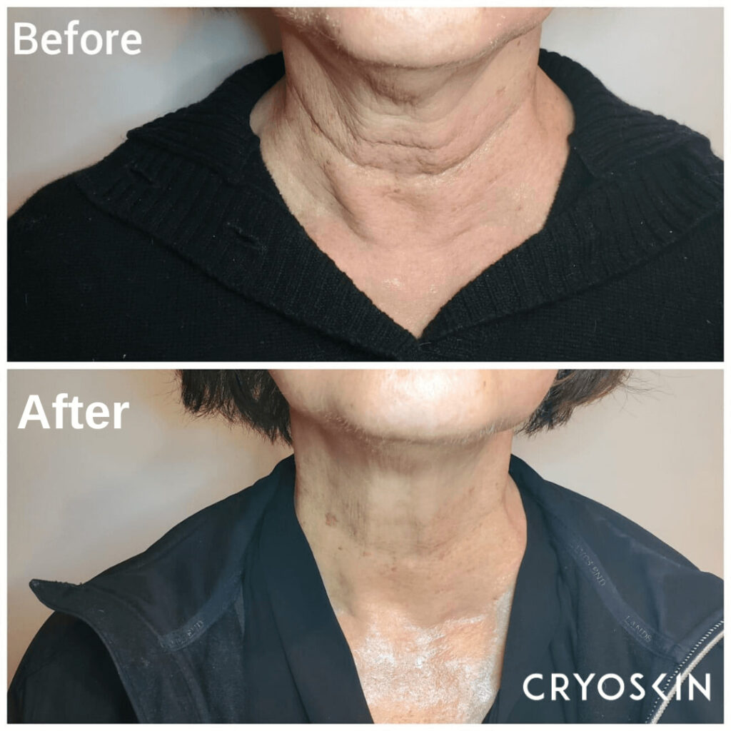 CryoFace Before and After