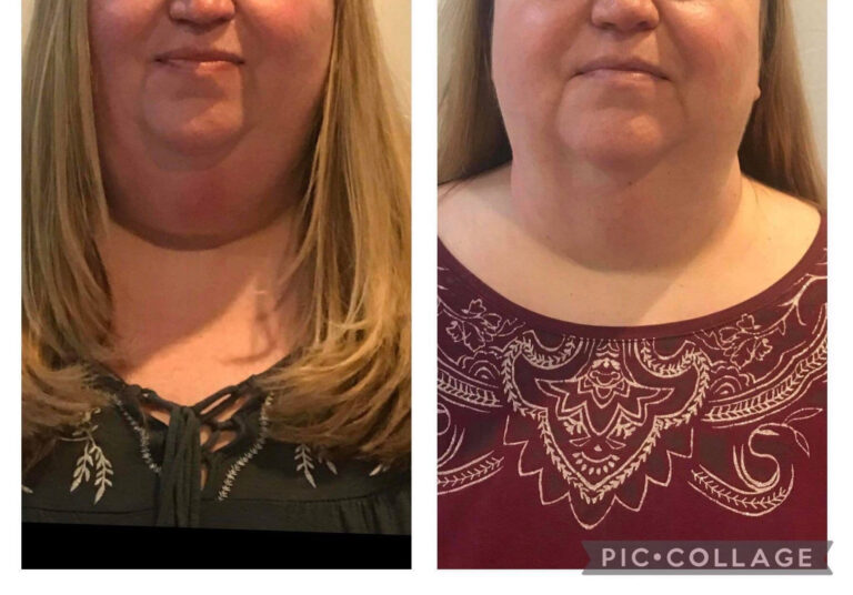 Double Chin Before and After