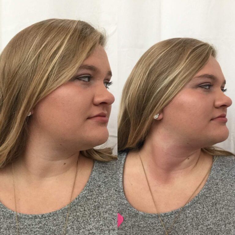 Double Chin Before and After