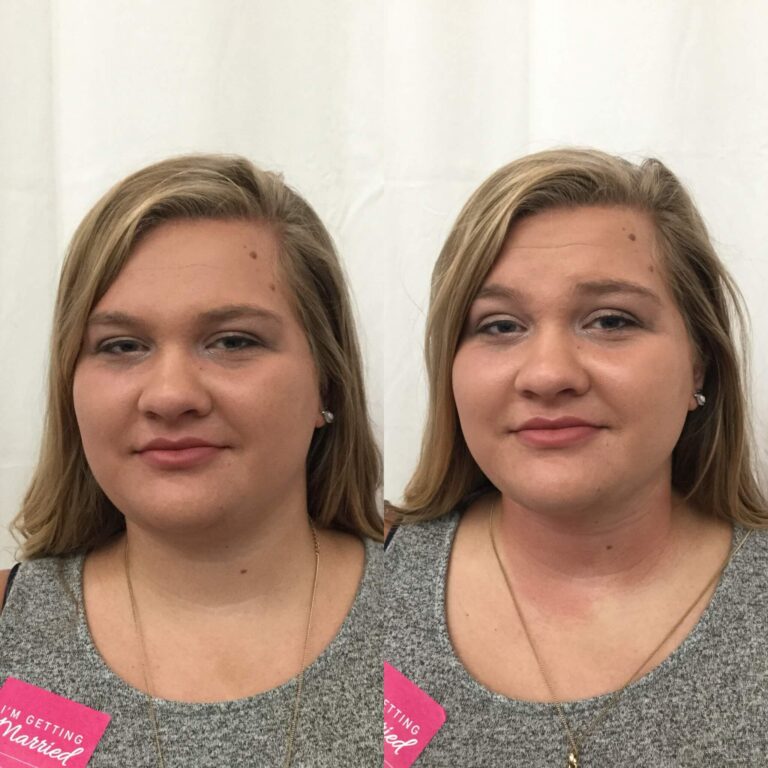 Double Chin Before and After