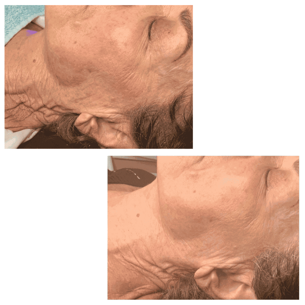 CryoFace Before and After