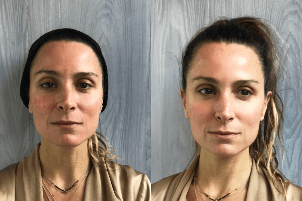CryoFace Before and After