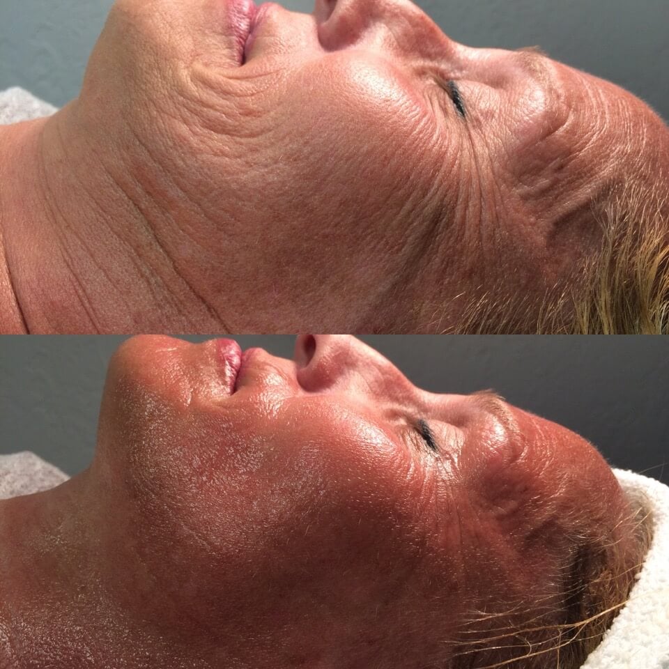 CryoFace Before and After